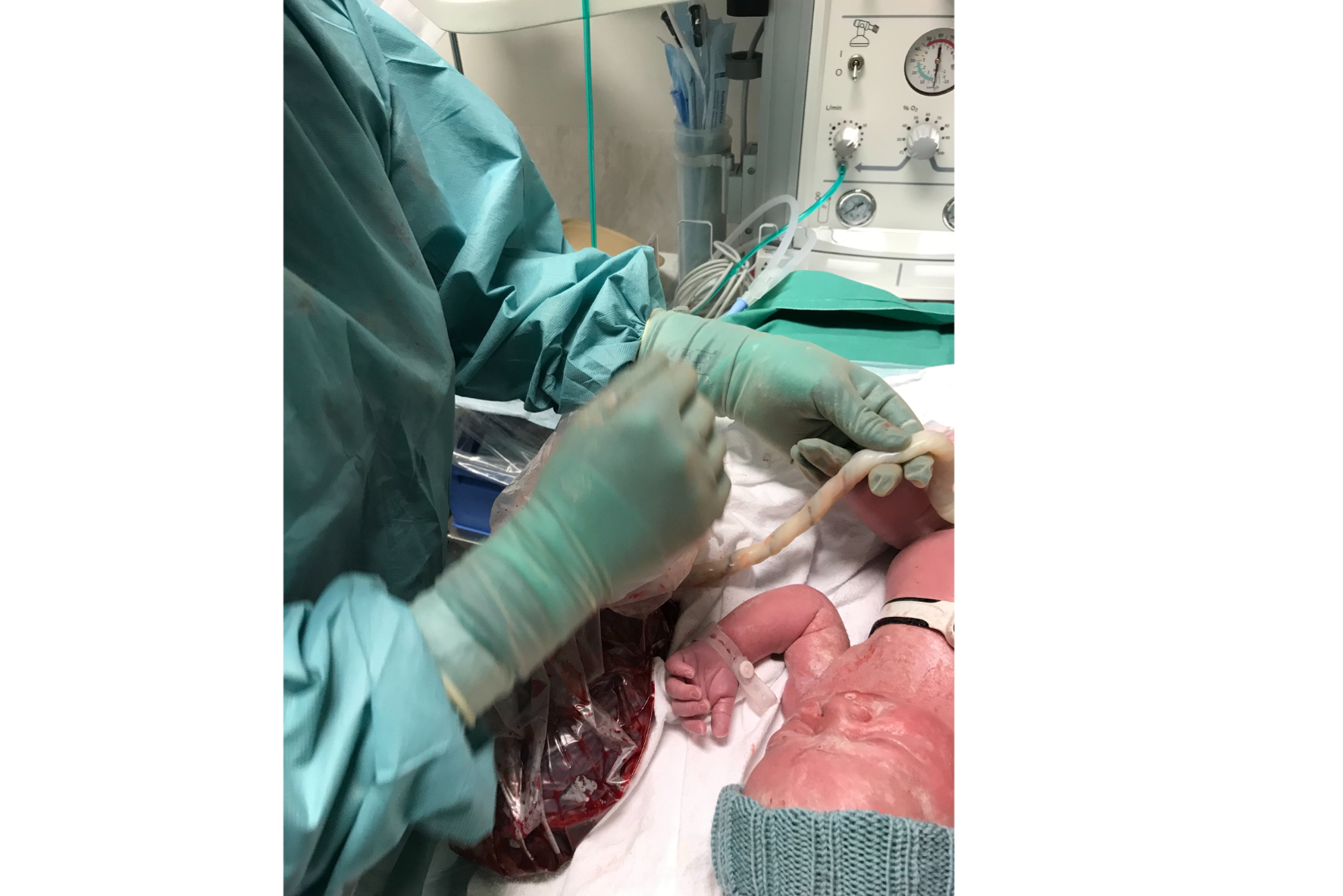 En nyfødt baby med intakt navlesnor