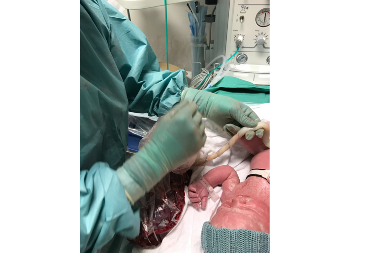 En nyfødt baby med intakt navlesnor